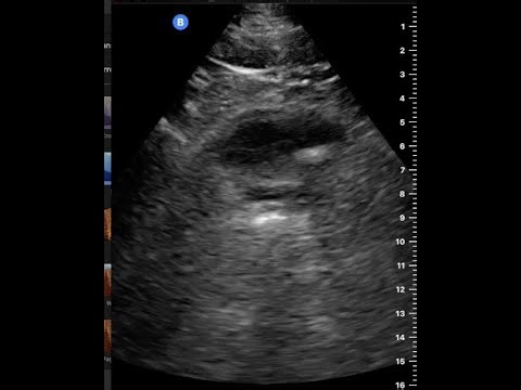 Left Flank Pain x 3 days in 18 y.o. Male: PoCUS BF iQ3 of Left Hydronephrosis and UVJ Bladder Stone