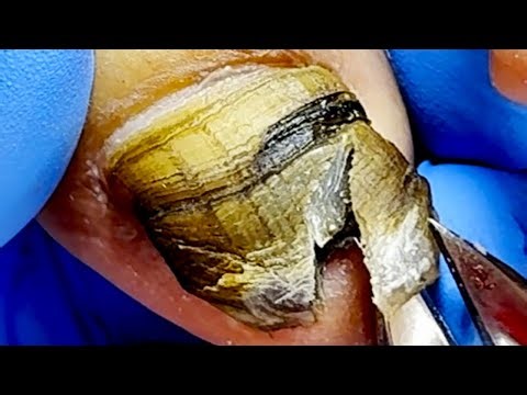 The Toenail Turned Black And Was Trimmed Successfully!【Podiatry Clinic】