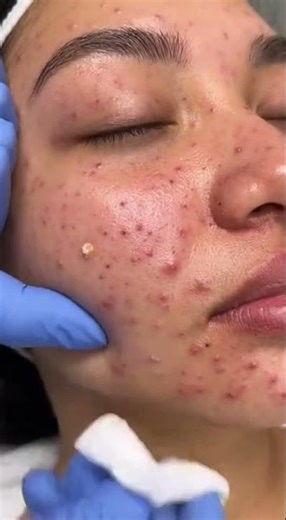 Relax Everyday With Sac Dep Spa Blackheads | Gigantic Blackhead Removal | Dep Sac Spa #144