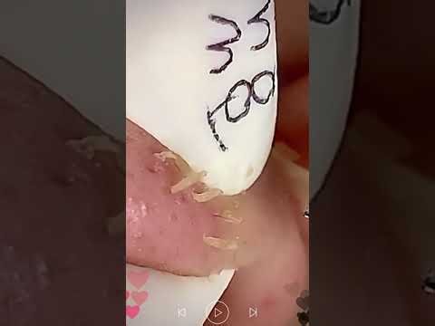 Skincare | Blackheads Removal #805 #tweezers skincare #blackheads blackheads