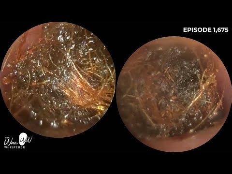 1,675 - Extreme Ear Wax Removal from Both Ears