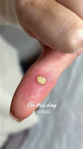 OMG Super Nose Blackheads removal satisfied videos #00