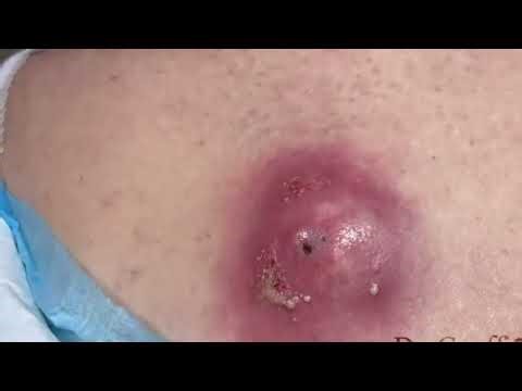Extreme Infected Epidermal Cyst Drainage | Satisfying Removal & Happy Easter