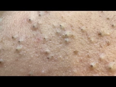 More black heads remove