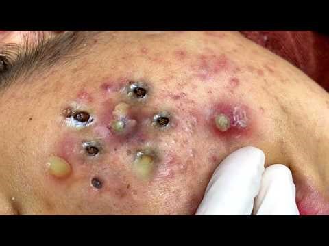 Viral Pimple Popping Compilation 🔥 Most Addictive Acne Videos 2026