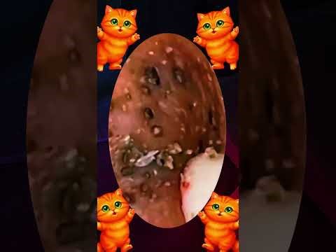 Blackheads Removal #299 | Acne Treatment and Very Satisfying Satisfying Pimple pop #blackheads