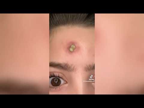 Pimple Popping - Ultimate Pimple Popping Compilation#89