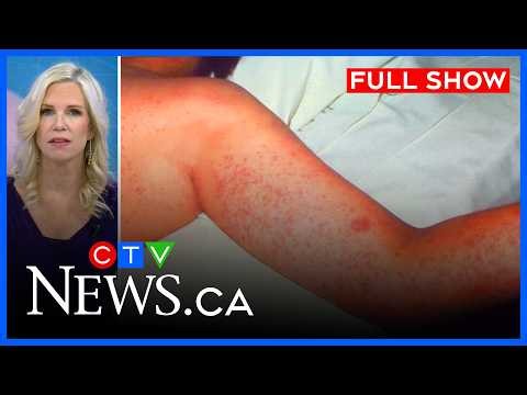 Measles exposure warning issued | CTV News Ottawa at Six for October 8, 2026