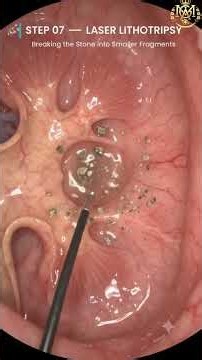 Kidney Stone Removal Surgery Explained Step by Step | Laser Lithotripsy