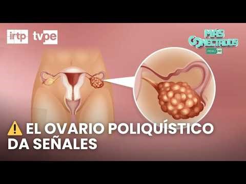 Ovario poliquístico: señales de alerta que toda mujer debe conocer | Más conectados