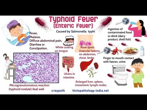 Differential Diagnosis of Typhoid Disease; other infectious and non infectious conditions