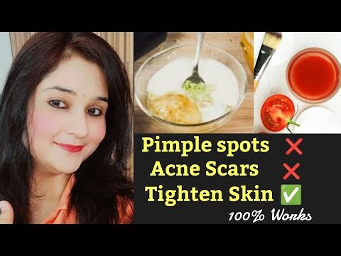 How to remove pimple spots, Acne Scars and get Tighten Skin | Home Remedy to get glowing bright skin
