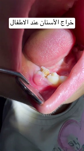 ُخراج الأسنان | Dental Abscess