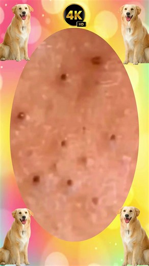 Blackheads Removal | Acne Treatment and Very Satisfying Satisfying Pimple pop #blackheads
