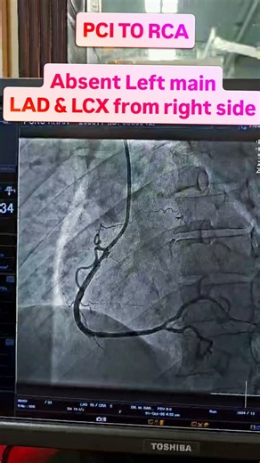 Anomalous LAD & LCX — Both Arising From the RCA! #interventionalcardiology #cardiology