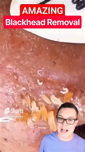 Breakthrough BLACKHEAD REMOVAL - This One Went Crazy Viral #shorts