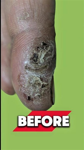 Painful Cracked Palms? See This Psoriasis Transformation! #chennaidermatologist #skincare