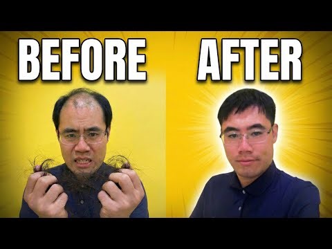How I Reversed My Hair Loss NATURALLY (Before & After)
