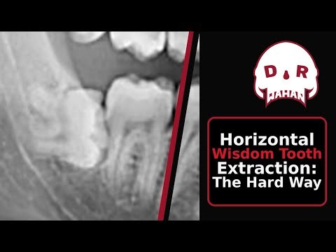 Horizontal Wisdom Tooth Extraction 