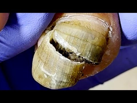 Trim Your Toenails Comfortably And Healthier~【Xue Yidao】