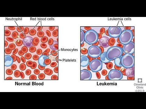 Causes, Etiology and Risk factors of Children Leukemia
