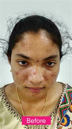 😥 Stop Picking Your Acne – Start Treating It! 💆‍♀️ Clear skin begins with the right care at VCare Clinic. ✅ Expert Doctors ✅ Safe & Effective ACNEX Treatment ✅ Prevent Permanent Skin Damage 🎉 FLAT 30% OFF on ACNEX – Limited Time! Step out with clear skin & boosted confidence 😎 📞 Call 8925984614 📲 Book Your Appointment Today! | VCare