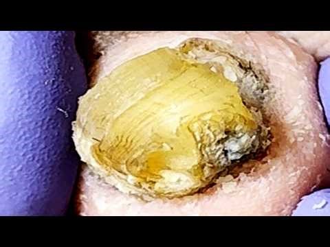 Stone Like Onychomycosis, A Stress Relief Pedicure~【Xue Yidao】