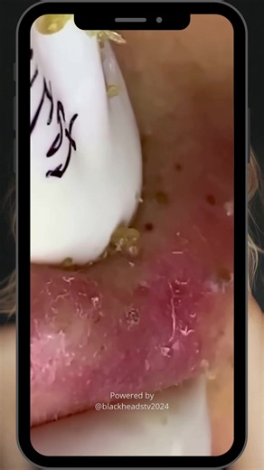 Squeeze Popping Acne Pimple Satisfying Abcess Blackheads Removal Pimple Removal | Viral #blackheadsremoval #cleanskin #acnetreatment #pimplepopping #foryoupage @BlackheadsTV
