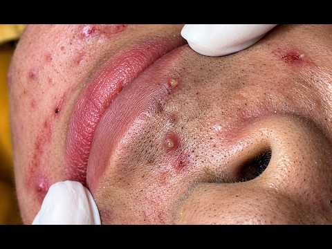 NEW 2026 😮‍💨 Satisfying Acne Removal Compilation | Blackheads & Pimples#10338