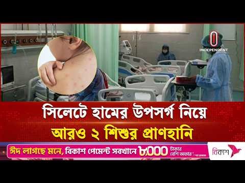 ওসমানী মেডিকেলে বাড়ছে হামে আক্রান্ত শিশুর সংখ্যা | Measles Outbreak | Public Health | Independent TV