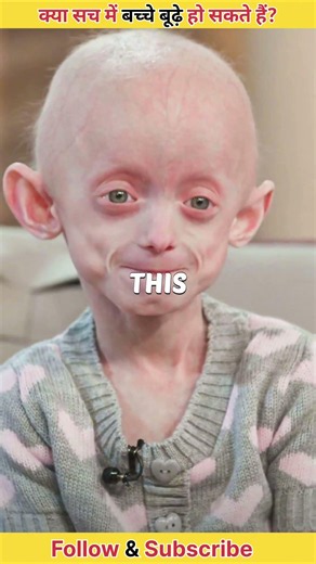 10 साल का बच्चा… लेकिन दिखता 80 साल का! 😨 | Progeria Diseaseबचपन में बुढ़ापा लाने वाली रहस्यमयी ।