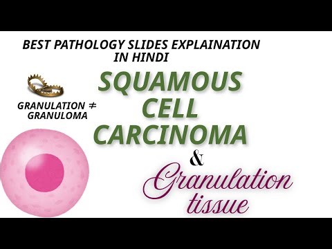 Granulation Tissue vs SCC | Must-Know Pathology Slides