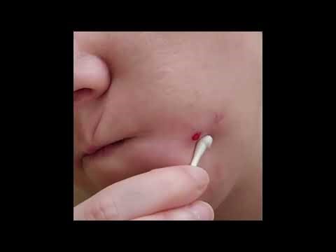 Satisfying Pimple Popping & Cyst Extractions - 201