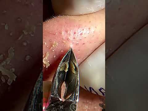 Skincare | Blackheads Removal #854 #tweezers skincare #blackheads blackheads