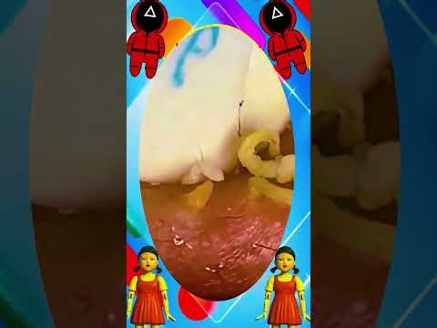 Blackheads Removal #387 | Acne Treatment and Very Satisfying Satisfying Pimple pop #blackheads