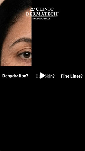 #clinicdermatech #livepowerfully #skinrejuvenation #nctf #deephydration #glowingskin #imrovedtexture | Clinic Dermatech