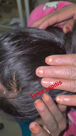 winter awareness #hair #haifall #haircare #dermatology #world #trending #shorts #short #youtube