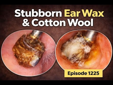 Stubborn Ear Wax and Cotton Wool Removed From Deep in the Ear - EP1225