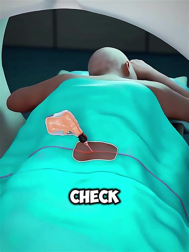 Bone Marrow Biopsy: What Happens During the Test? #bonemarrow #bonemarrowbiopsy #bonemarrowtransplant #medicalanimation