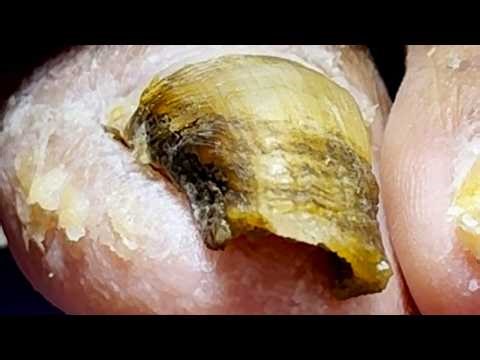 Onychomycosis Becomes Clean Step By Step【Xue Yidao】
