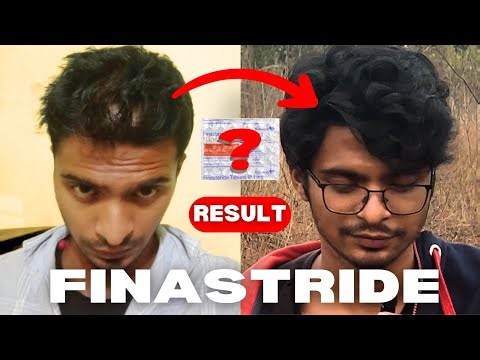 How I Stopped Hair Fall in 4 Months Using Finasteride | Results, Side Effects & Truth