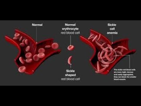 Sickle cell Disorders As a Hemoglobinopathy; structural abnormality in hemoglobin molecule