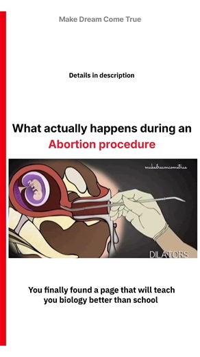 🤰🏻 What Actually Happens 💊 During an Abortion procedure 👩‍⚕️ | MDCT