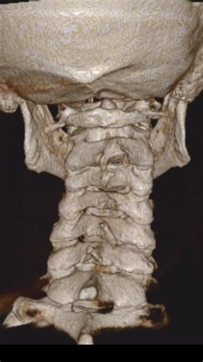 Cranio Cervical Instability: Is Your Upper Neck the Cause?