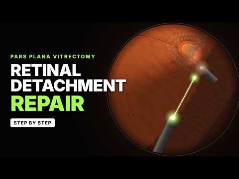 Rhegmatogenous Retinal Detachment Surgery Step by Step