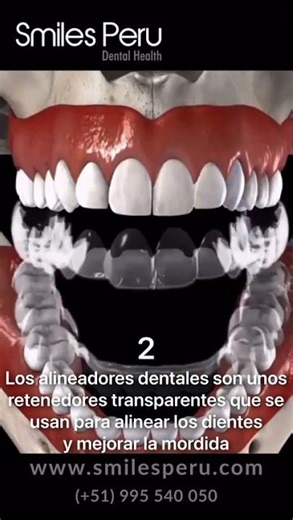 Alineador dental y mordida cruzada anterior/ Dental aligner and posterior crossbite