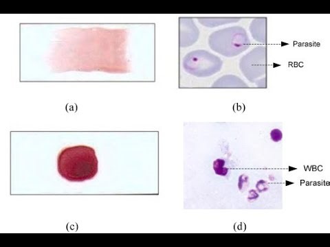 Thick and thin film and peripheral blood smear for malaria Parasite