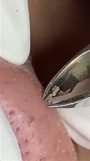 BLACKHEAD REMOVAL #005