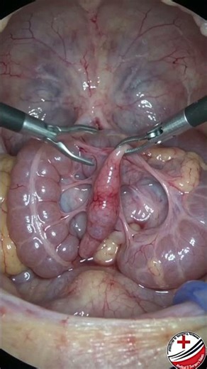 Laparoscopic Appendectomy (Keyhole Appendix Removal).#LaparoscopicAppendectomy #AppendixRemoval