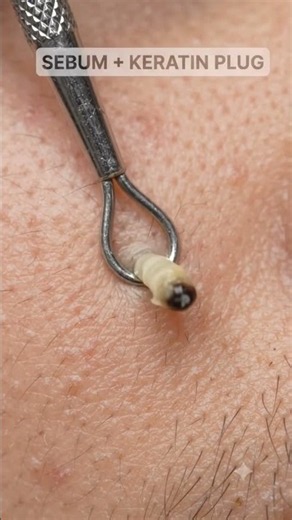 Blackhead Removal 🖤 What’s Actually Inside the Pore? #Blackheads #Skincare